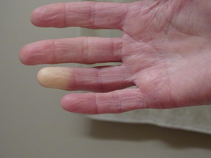 Do Compression Socks Relieve Raynaud’s Symptoms?