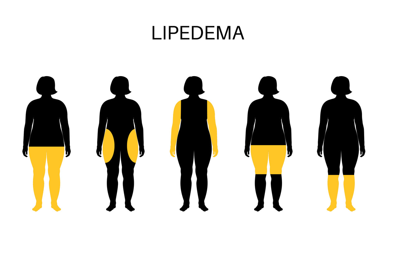 How Compression Socks are Used to Treat Lymphedema and Lipedema