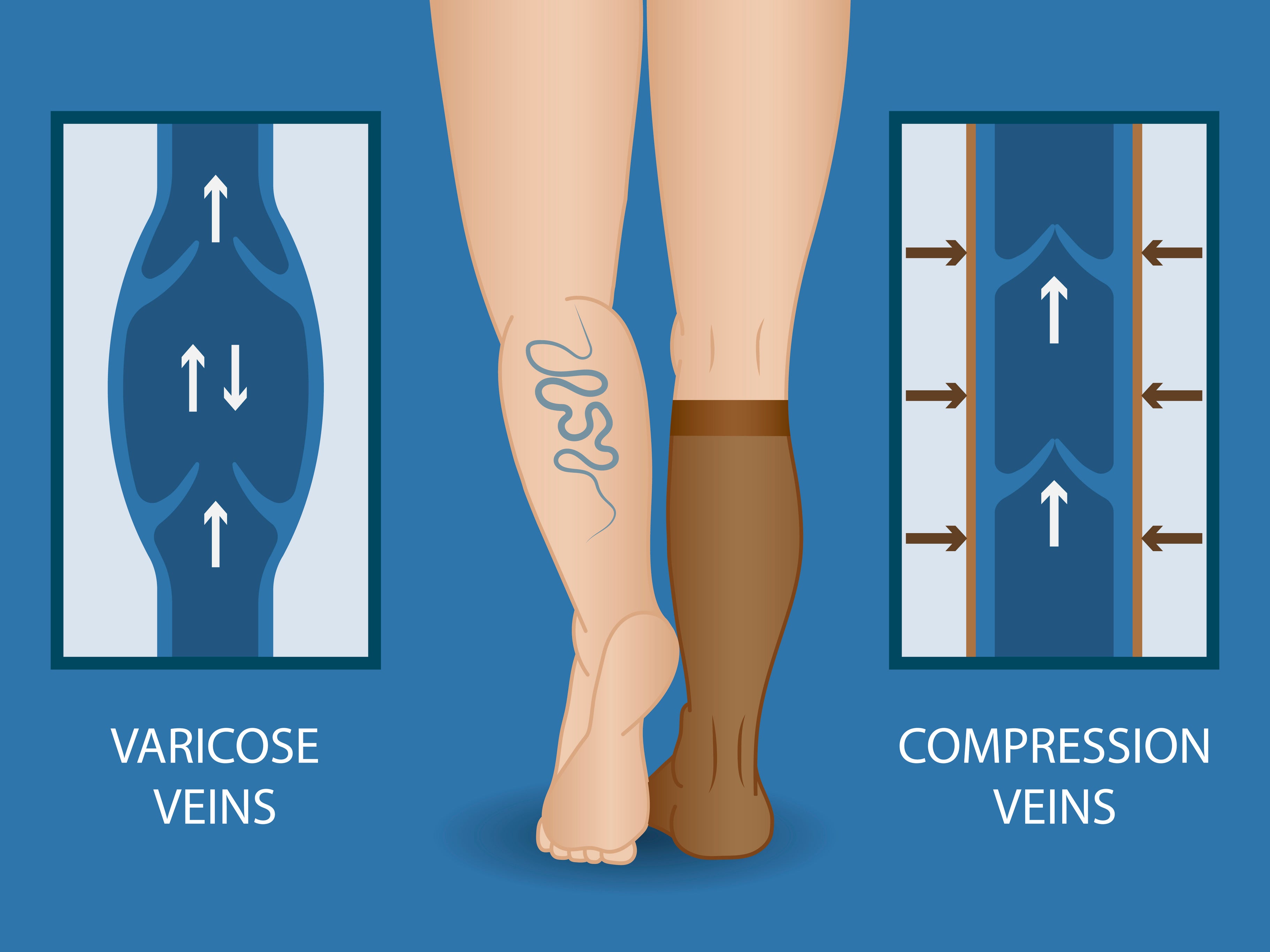 Compression Socks Varicose Veins Knee High Nurse Teacher Medical Stockings  - China Compression Socks and Compression Stockings price |  Made-in-China.com